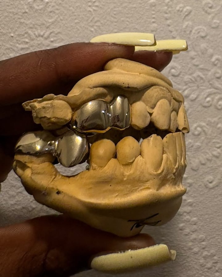Close-up of polished caps on a dental mould